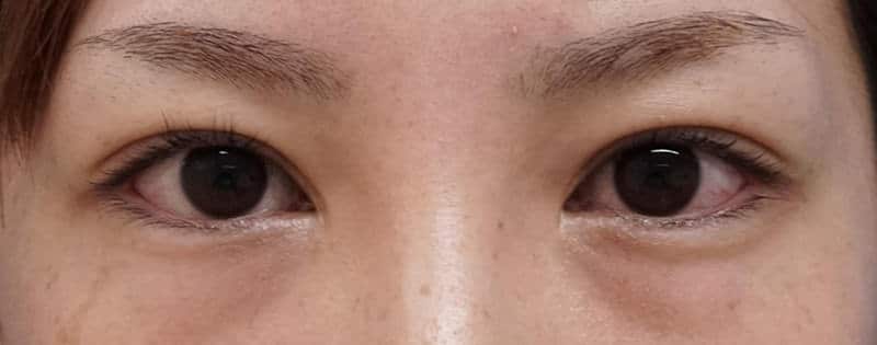 ラインを狭く。他院抜糸（８点）、もとびアイゴールド、厚み取り　　３ヶ月半後のAfter写真