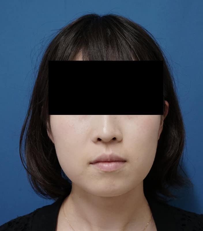 アラガン強力小顔ボトックス　1か月後のAfter写真