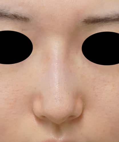 隆鼻術（Ｉ型プロテーゼ）　1週間後のAfterの写真
