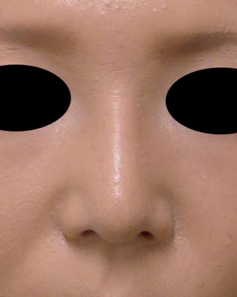 鼻尖形成３Ｄ法、Ｉ型プロテーゼ　3ヶ月後のAfterの写真