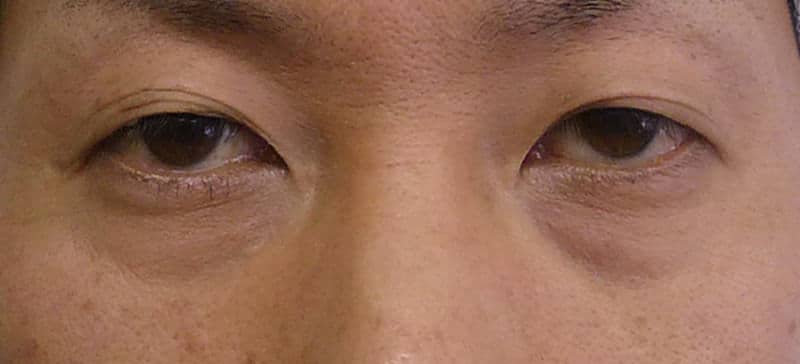 目の下の脂肪とり＋コンデンス脂肪注入（目の下）　半年後のBefore写真