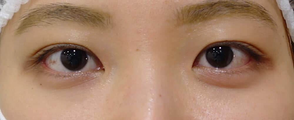 鼻尖縮小＋軟骨移植＋ストラット、鼻翼縮小（内＋外）　３ヶ月後　正面のBefore写真