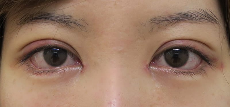 下眼瞼下制（たれ目形成術）、目頭切開、もとびアイプラチナム　1週間後のAfterの写真