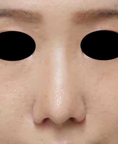 鼻尖形成、鼻尖部軟骨移植、flap法　5ヶ月後のAfter写真