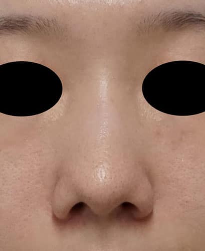 鼻尖縮小＋軟骨移植＋ストラット、鼻翼縮小（内＋外）　３ヶ月後　正面のBefore写真