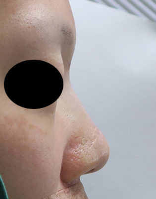 高めのお鼻プロテーゼ　１週間後のBefore写真