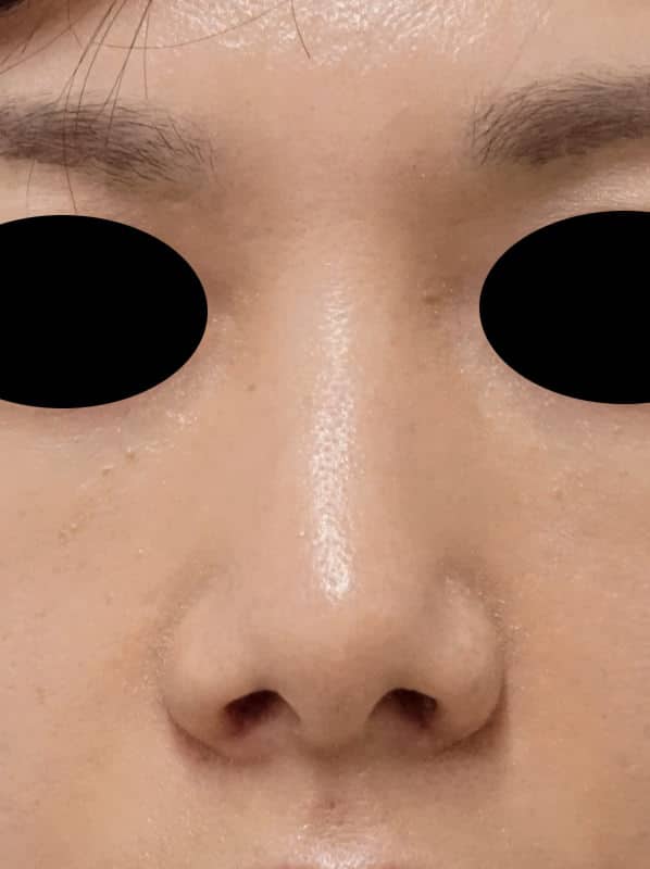小鼻縮小(内側法、flap法) 1週間後のAfterの写真