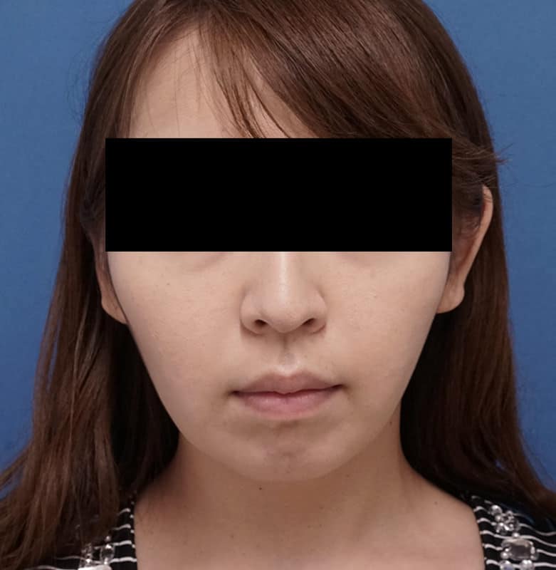 しっかりした小顔効果！｜切らない強力小顔3点セット　3ヶ月後のAfter写真