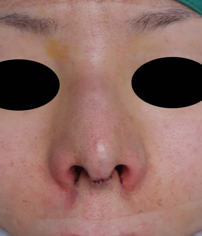 鼻中隔延長、隆鼻術、小鼻縮小（flap法）の手術直後のAfterの写真