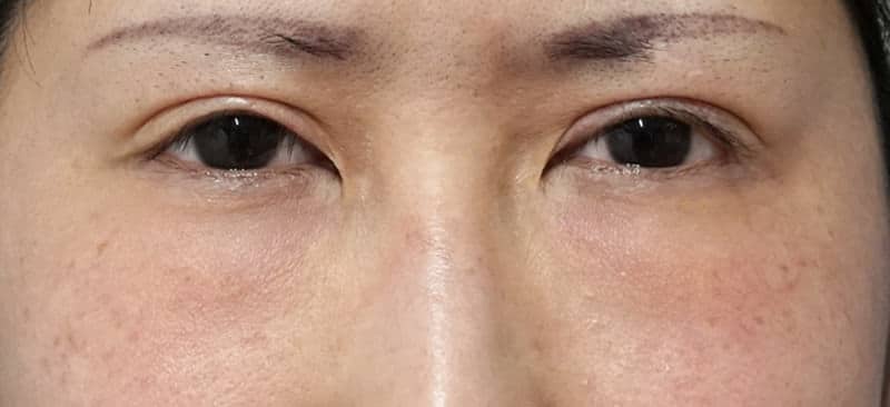 他院の目の下脂肪注入後のしこり除去、修正手術　1ヶ月後のBefore写真