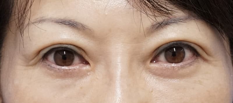 他院二重埋没法修正、抜糸（5点）＋スマートバランス 　1ヶ月後のAfter写真