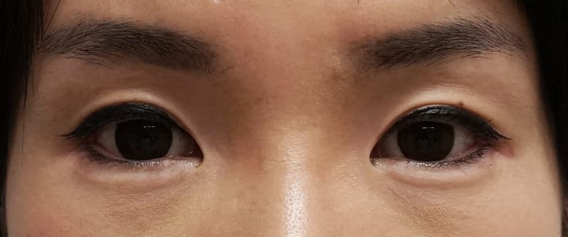 涙袋形成（ヒアルロン酸）　処置直後の画像です。のAfterの写真
