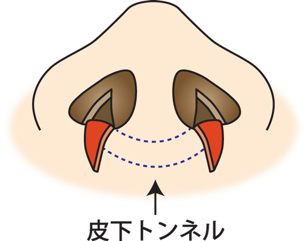 鼻翼縮小（フラップ法）トン
