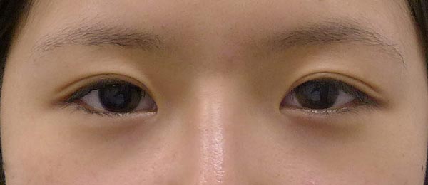 傷が目立ちにくい目頭切開（リドレープ法）　3ヶ月後のBefore写真