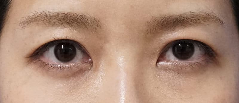 目をぱっちり華やかに|切らない眼瞼下垂プレミアム 3ヶ月後のAfterの写真