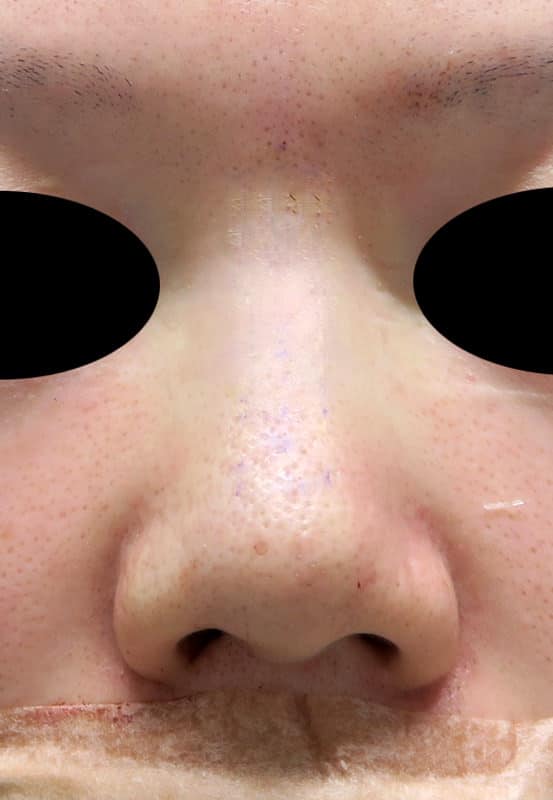 お鼻のプロテーゼ　3ヶ月後のBefore写真