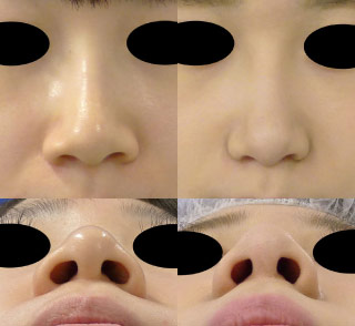 小鼻を小さく-処置前後-flap法2
