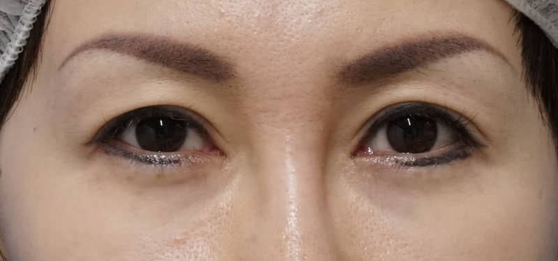 目の上のたるみを二重プチ整形で改善　もとびアイプラチナム　１ヶ月後のBefore写真