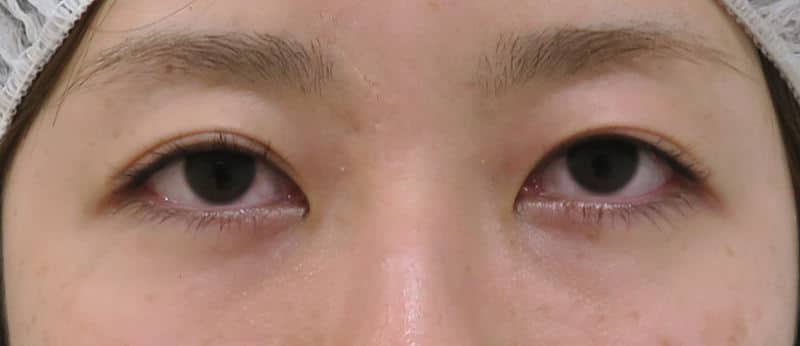 目をぱっちり華やかに｜切らない眼瞼下垂プレミアム　3ヶ月後のBefore写真