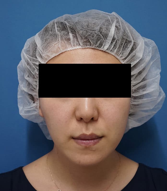 糸で簡単若返り|プレミアムショッピングスレッド 処置直後のBefore写真