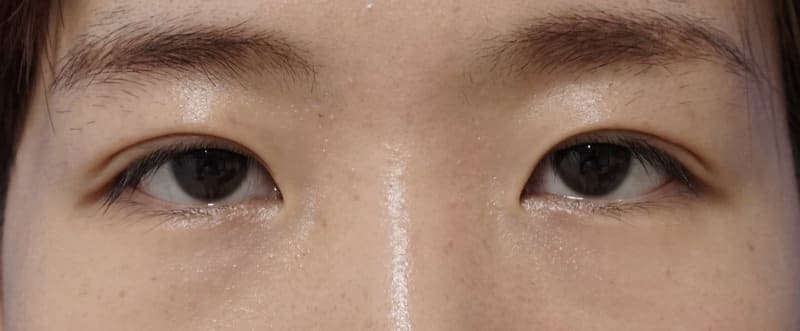 スマートバランス 1ヶ月後のAfterの写真