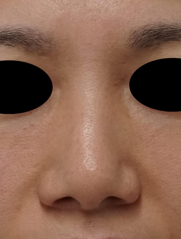 小鼻縮小(内側法、flap法) 1週間後のBefore写真