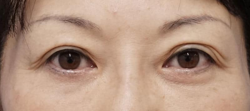 鼻尖縮小＋軟骨移植＋ストラット、鼻翼縮小（内＋外）　３ヶ月後　正面のBefore写真