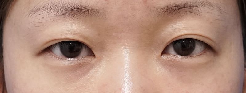 他院抜糸2点、もとびアイプラチナムの1ヶ月後のBefore写真