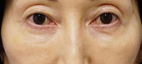 鼻尖縮小＋軟骨移植＋ストラット、鼻翼縮小（内＋外）　３ヶ月後　正面のBefore写真