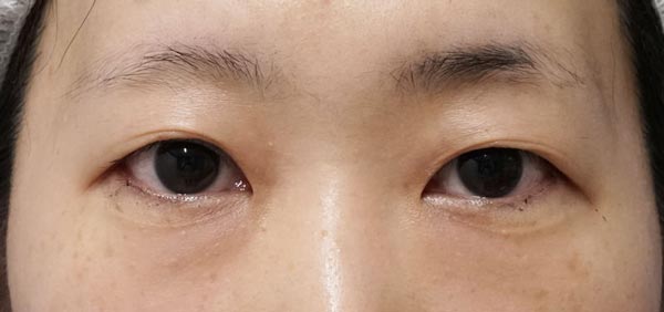 鼻尖縮小＋軟骨移植＋ストラット、鼻翼縮小（内＋外）　３ヶ月後　正面のBefore写真
