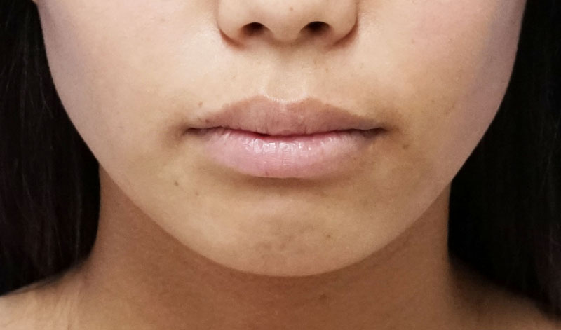 鼻尖縮小＋軟骨移植＋ストラット、鼻翼縮小（内＋外）　３ヶ月後　正面のBefore写真
