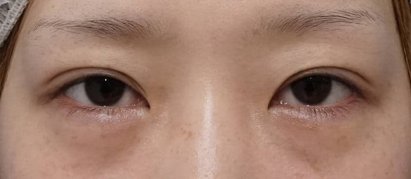 切らない眼瞼下垂　7ヶ月後のBefore写真