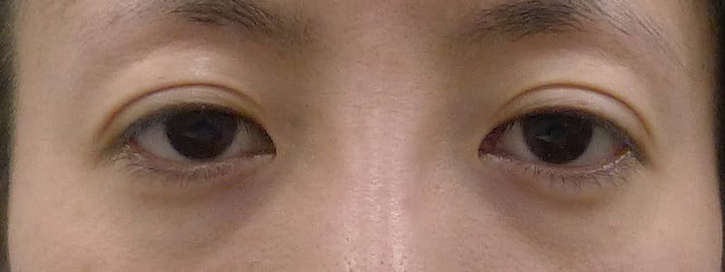 切らずに眠たい目を明るく｜切らない眼瞼下垂　1か月後のBefore写真