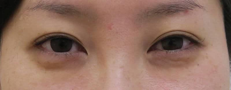 他院抜糸(8点)、もとびアイプラチナム 1週間後のBefore写真