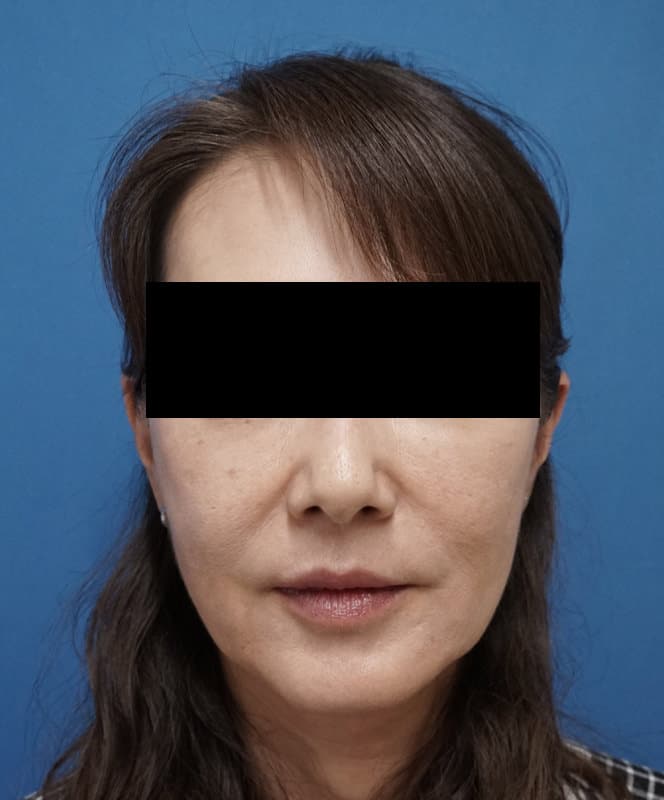 鼻尖縮小＋軟骨移植＋ストラット、鼻翼縮小（内＋外）　３ヶ月後　正面のBefore写真