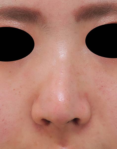 団子鼻をきれいに整える整形　鼻尖形成（3D法）＋小鼻縮小（flap法） 5日後のAfterの写真