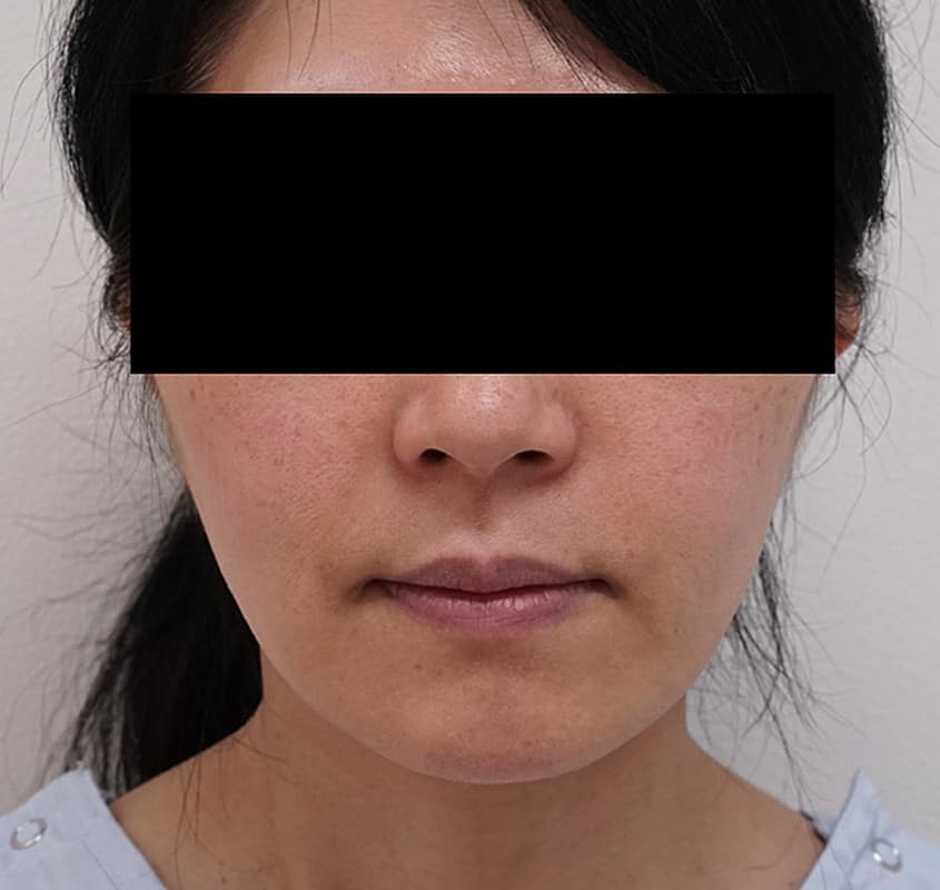 フェイスリフト（ホホ）１週間後の腫れは？のBefore写真