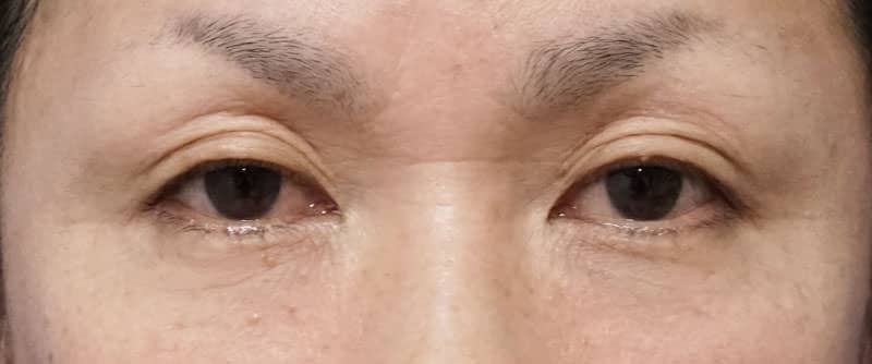 全切開、眼瞼下垂　１週間後、１ヶ月後のBefore写真