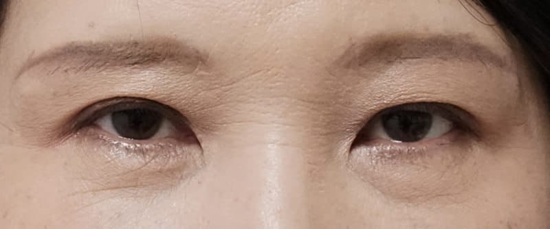 自然な目の上の若返り　眉下切開　3ヶ月後のAfter写真