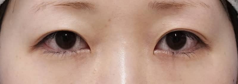 美容スタッフさんのもとびアイプラチナム 1週間後のBefore写真