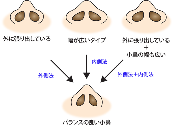 タイプ別鼻翼縮小の種類