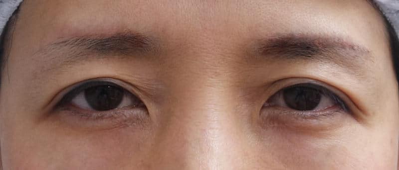 自然な目の上の若返り｜眉下切開　1ヶ月後のBefore写真