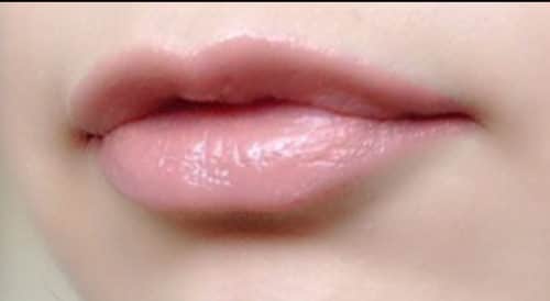 ふっくらセクシーなアヒル口に｜上口唇のヒアルロン酸のAfterの写真