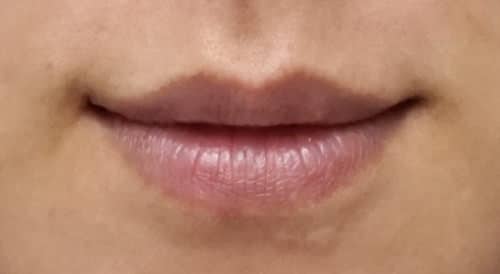 ふっくらセクシーなアヒル口に｜上口唇のヒアルロン酸のBefore写真