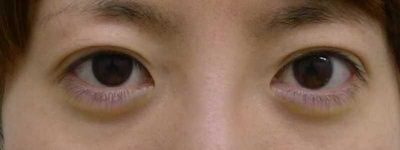 切らずに眠たい目を明るく｜切らない眼瞼下垂　1か月後のAfter写真