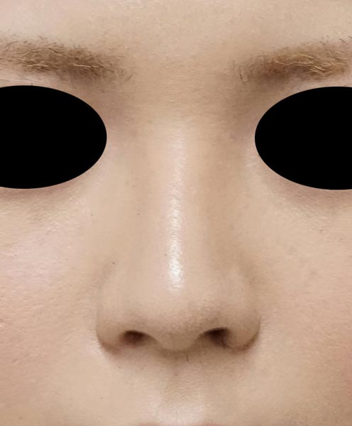 傷が見えない小鼻縮小、flap法　2ヶ月後のAfter写真