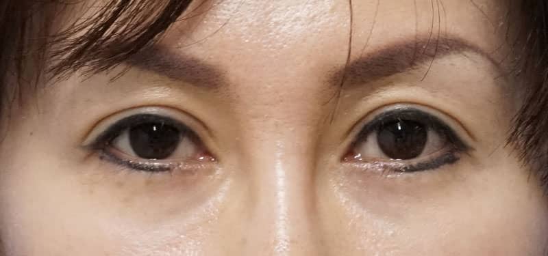 目の上のたるみを二重プチ整形で改善　もとびアイプラチナム　１ヶ月後のAfterの写真