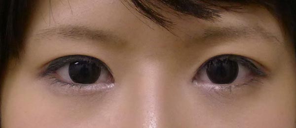傷が目立ちにくい目頭切開（リドレープ法）　3ヶ月後のAfter写真
