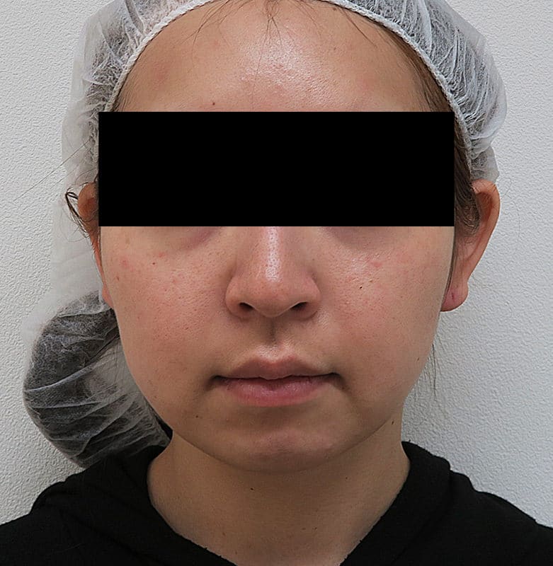 鼻尖縮小＋軟骨移植＋ストラット、鼻翼縮小（内＋外）　３ヶ月後　正面のBefore写真