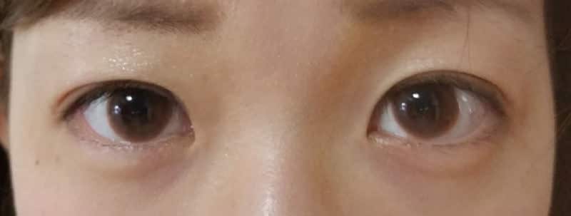 他院抜糸(2点)、もとびアイプラチナム 1週間後のAfterの写真